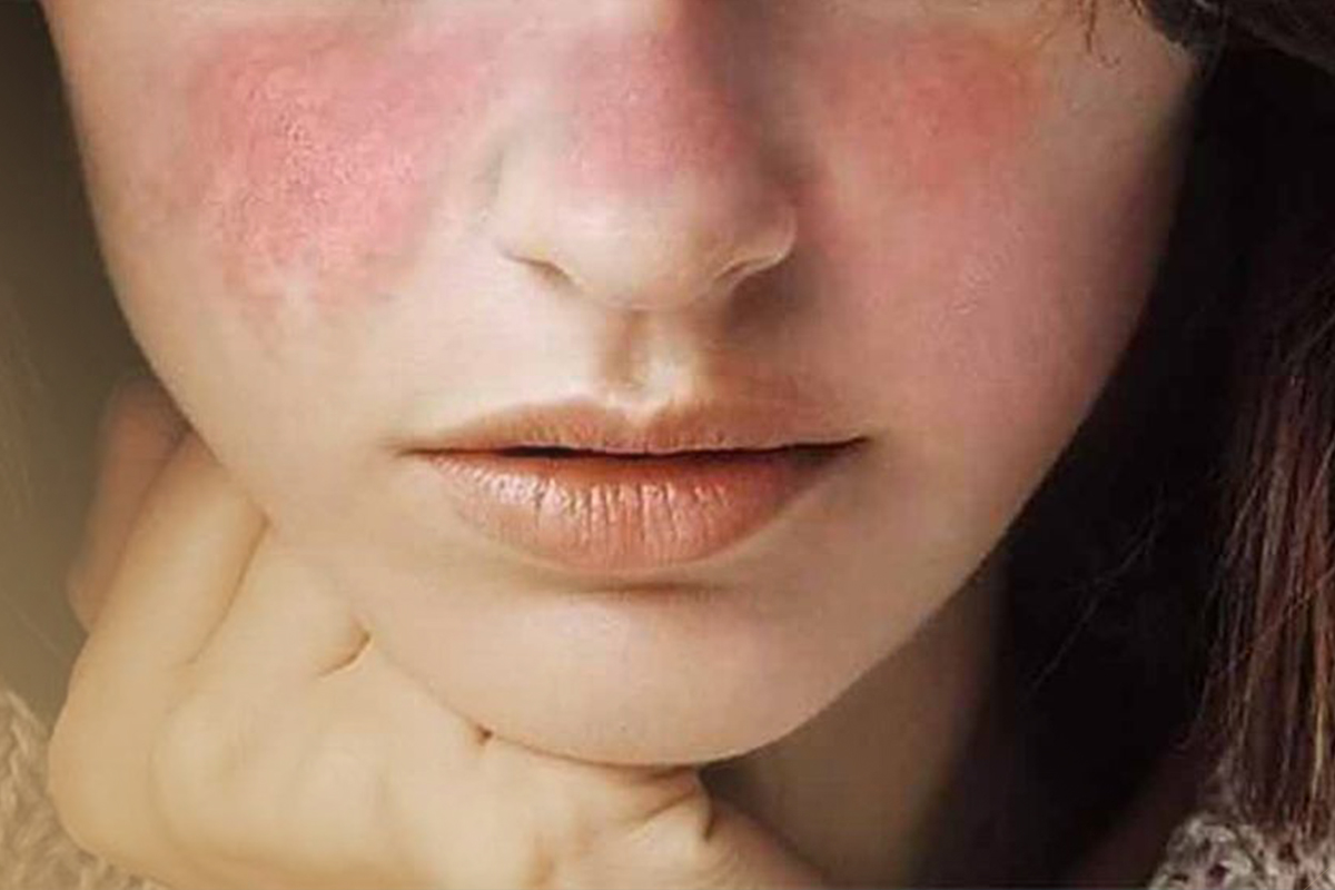 باید ها و نباید ها برای لوپوس و امور زیبایی