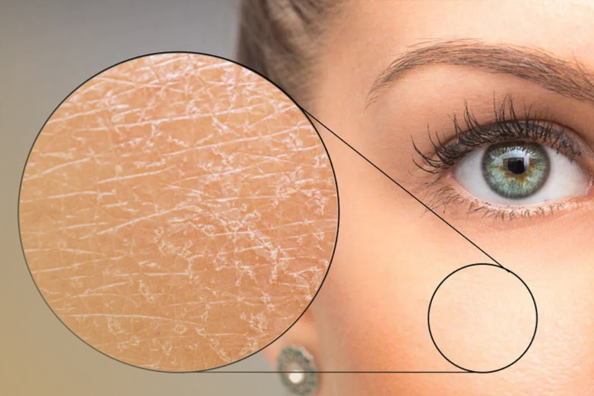 راهکارهای مقابله با خشکی پوست